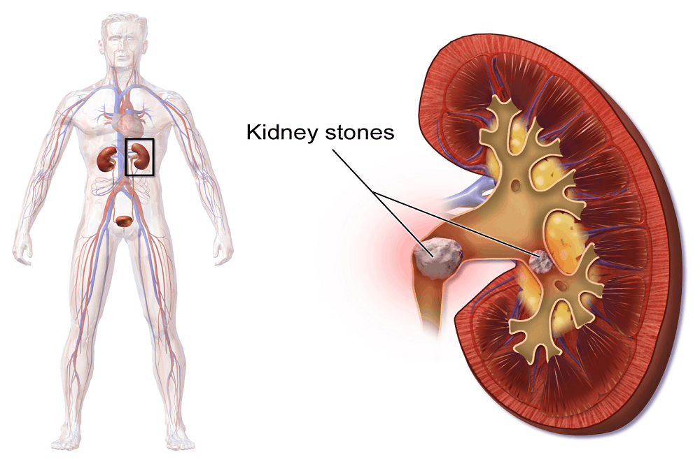 Percutaneous Nephrolithotomy : परक्यूटेनियस नेफ्रोलिथोटॉमी क्या है?