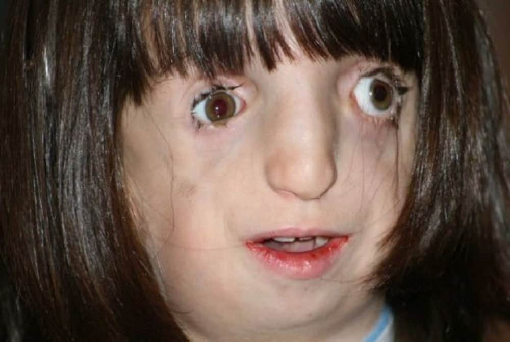 Treacher Collins syndrome : ट्रेचर कॉलिंस सिंड्रोम क्या है?