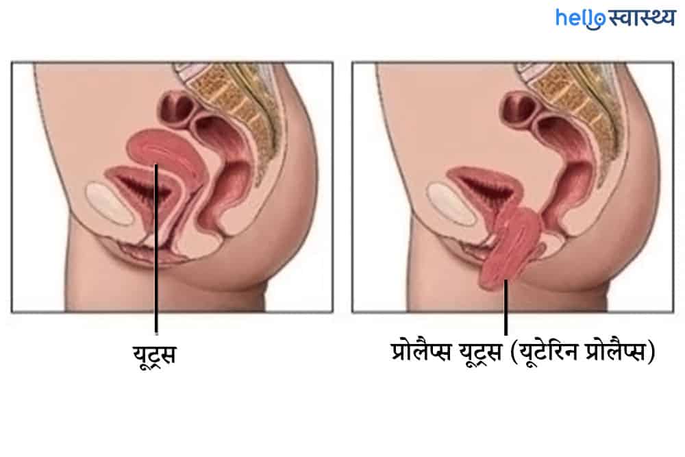यूटेरिन प्रोलैप्स (गर्भाशय भ्रंश): गर्भाशय क्यों आ जाता है अपनी जगह से नीचे?
