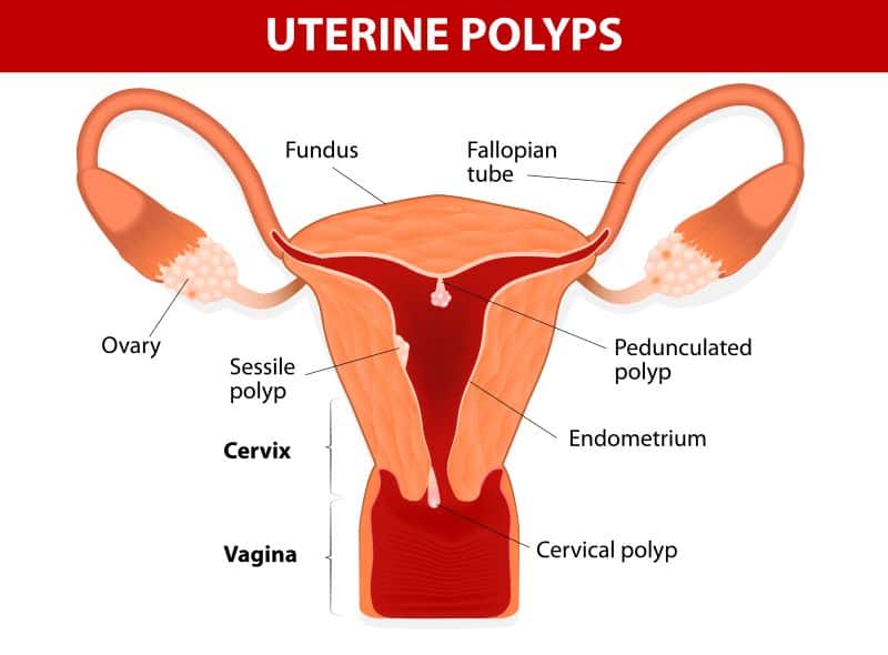 गर्भाशय पॉलिप्स (Uterine Polyps) क्या है? जानिए इसके कारण, लक्षण और इलाज