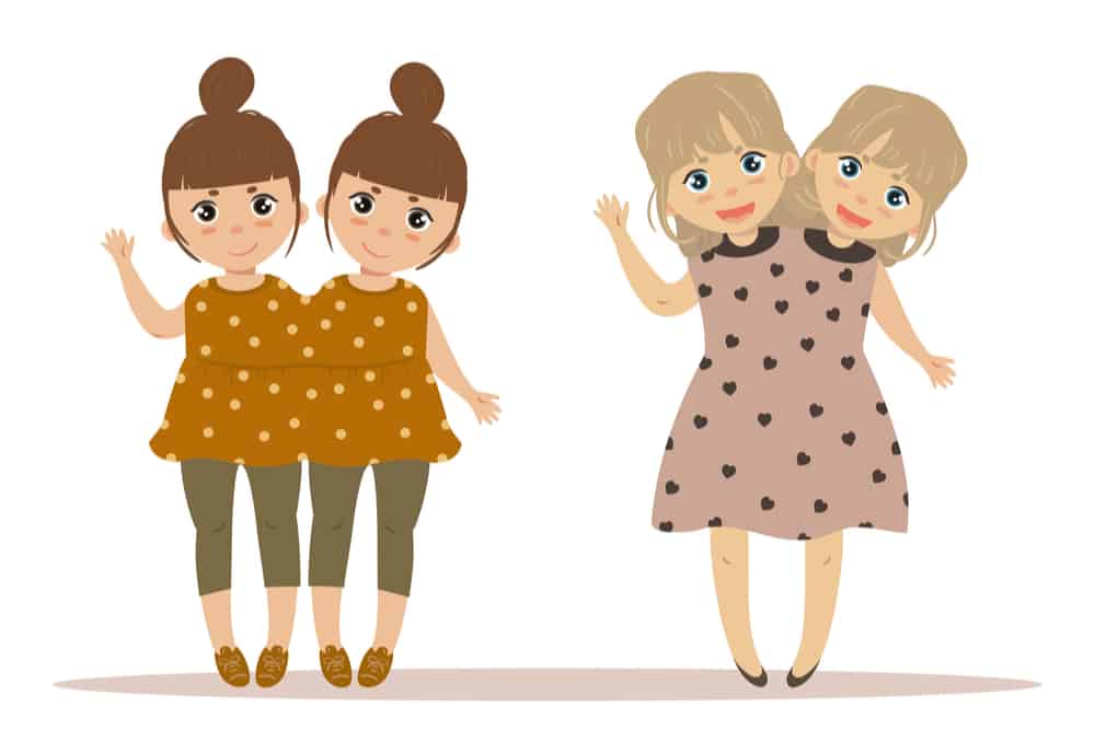 कोज्वाॅइंट ट्विन्स का जीवन नहीं रहता है आसान, जानें बचने की रहती है कितनी संभावना?