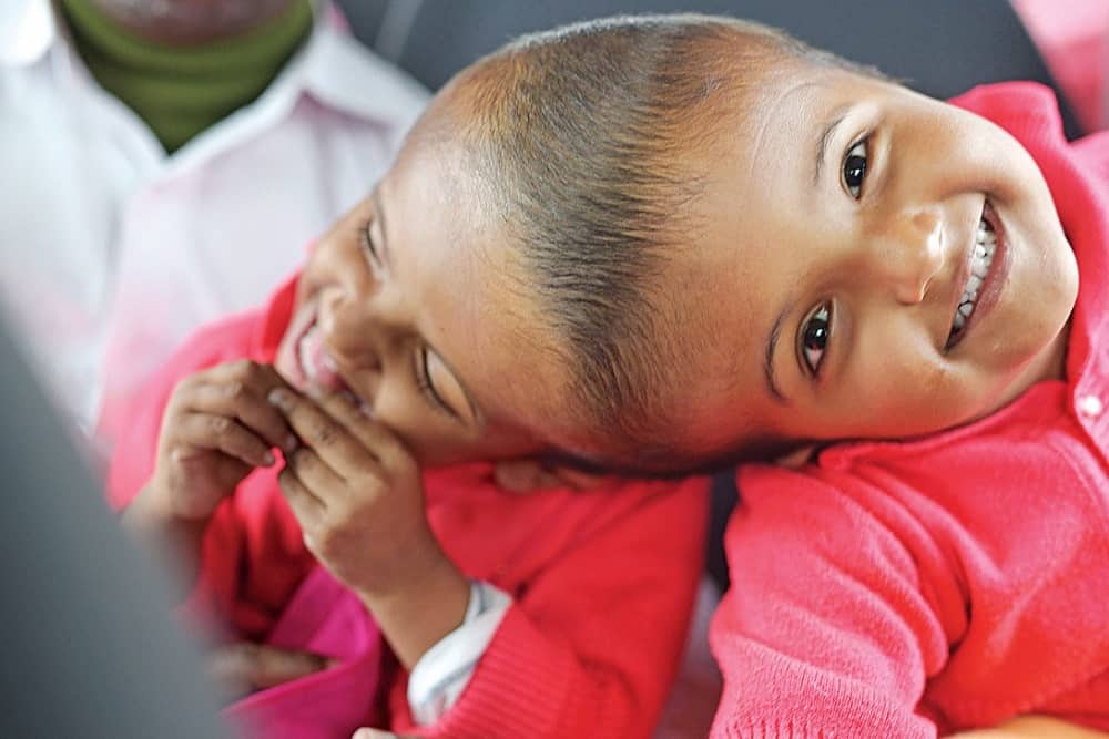 जॉइंट ट्विन्स कैसे होते हैं? जानिए इनके जीवन के बारे में महत्वपूर्ण बातें