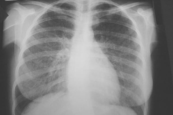 Pneumonitis: निमोनाइटिस क्या है?