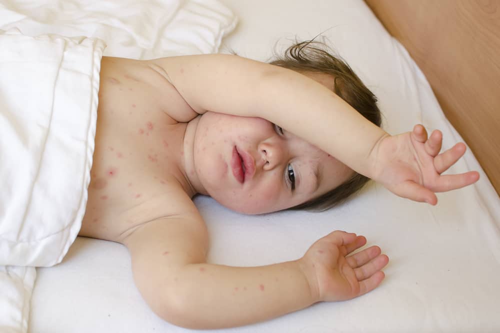 बच्चों में चिकन पॉक्स (Chickenpox) का क्या है इलाज?