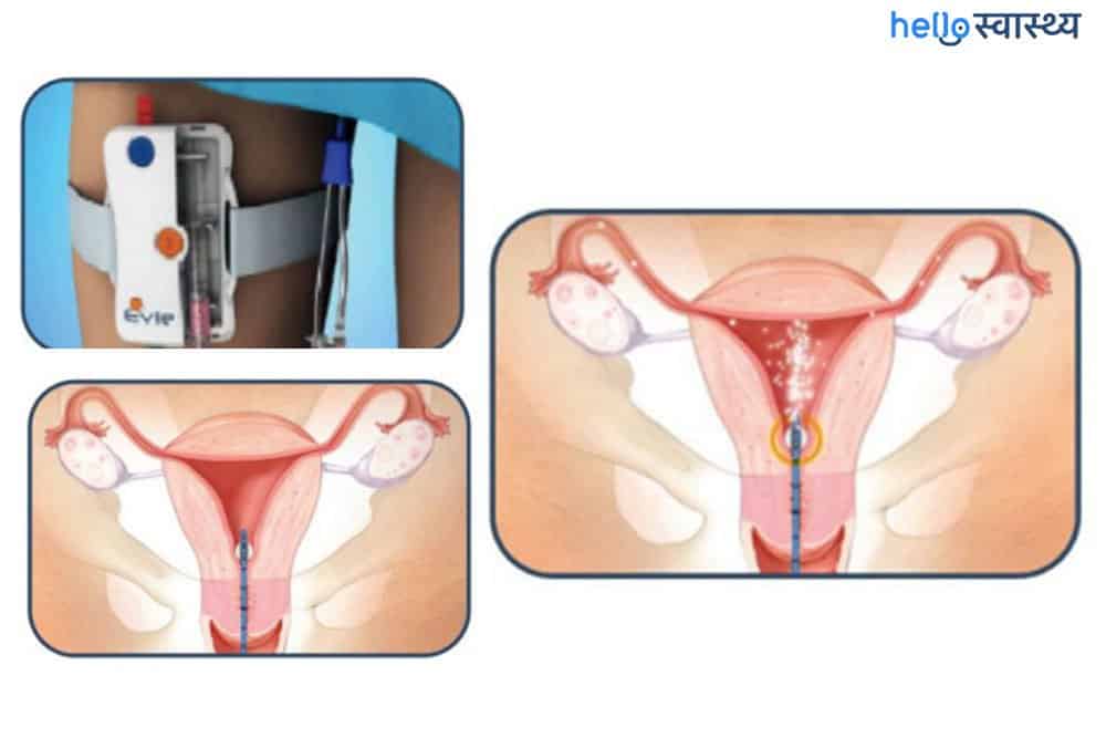 स्लो रिलीज इनसेमिनेशन (SRI) क्या है? किस तरह गर्भधारण में है मददगार?