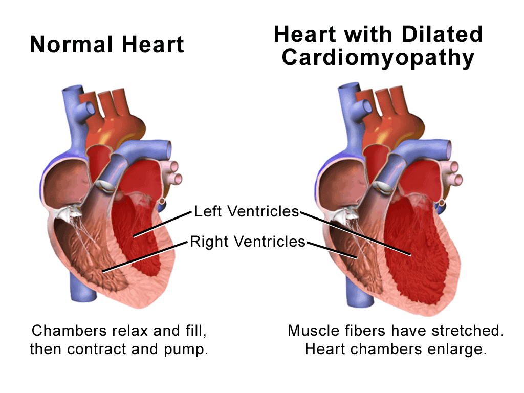 Dilated Cardiomyopathy: डायलेटेड कार्डियोमायोपैथी क्या है?