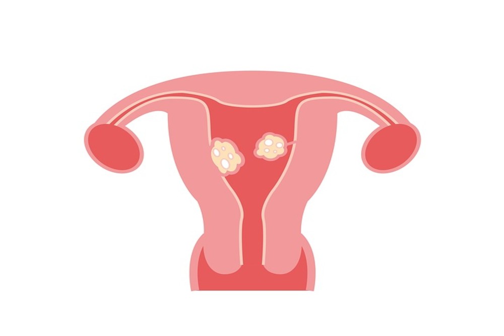 हर महिला के लिए जानना जरूरी है फाइब्रॉएड से जुड़े मिथक