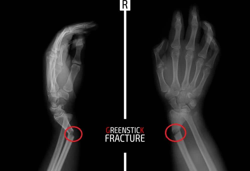 Greenstick Fracture: ग्रीनस्टिक फ्रैक्चर क्या है? जानें इसके कारण, लक्षण और उपाय