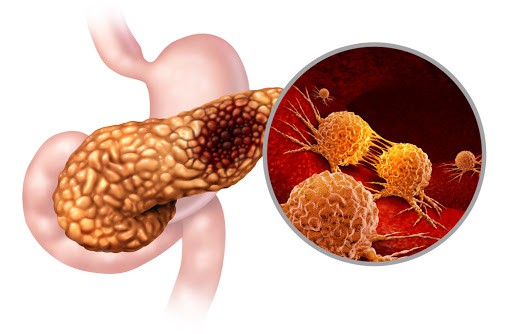 पैंक्रिएटिक कैंसर सेल्स को 90 फीसदी तक खत्म कर सकता है यह मॉलिक्यूल