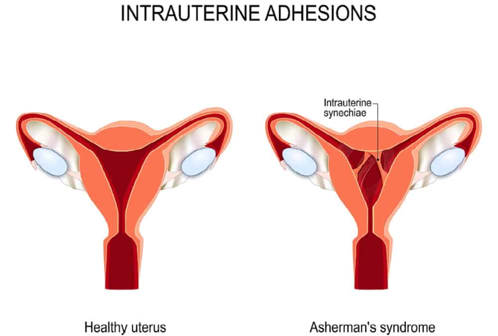 Asherman's Syndrome: आशरमेंस सिंड्रोम क्या है?