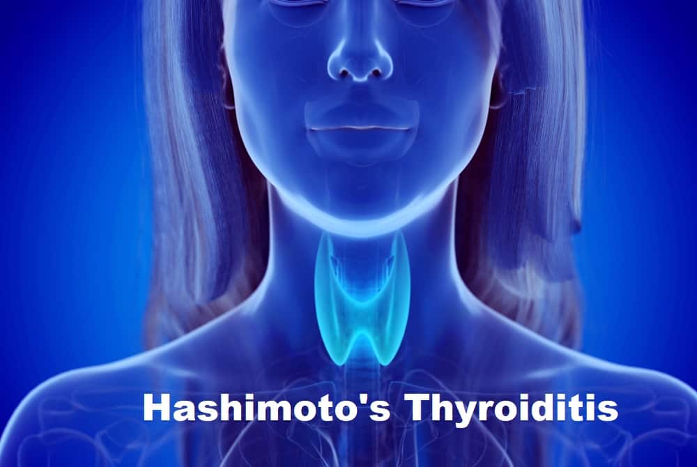 जानें क्या है हाशिमोटोस थाईरॉइडाईटिस? इसके कारण और उपाय