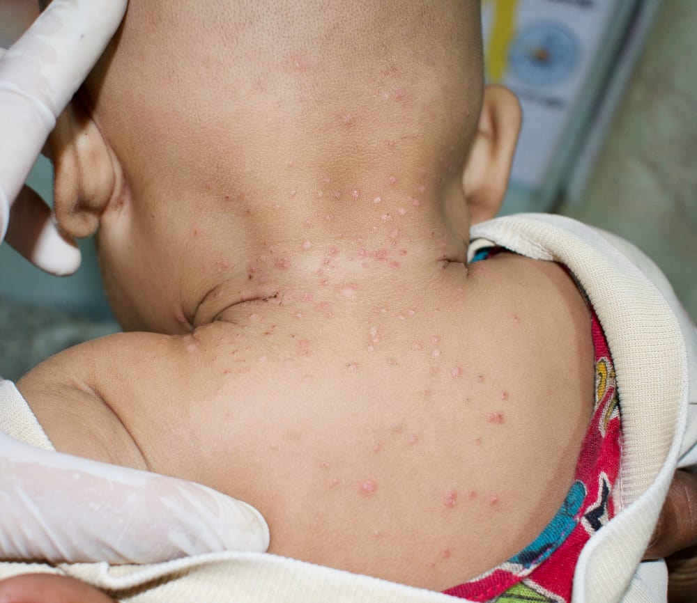 बच्चों में 'मोलोस्कम कन्टेजियोसम' बन सकता है खुजली वाले दानों की वजह