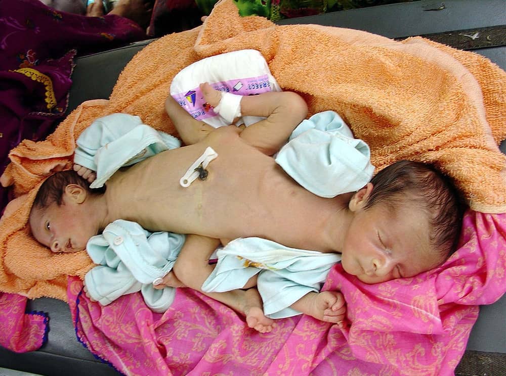 क्या कंज्वाइंड ट्विन्स की मौत एक साथ हो जाती है?