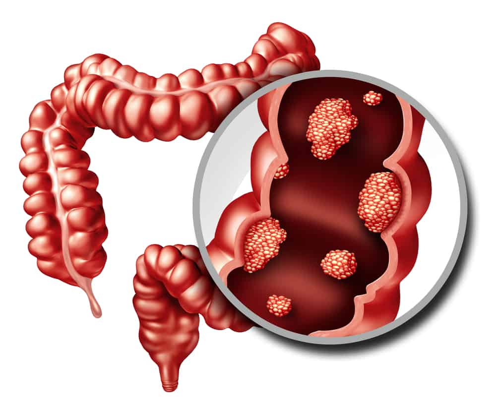 Colorectal Cancer: कोलोरेक्टल कैंसर क्या है? जानिए इसके कारण, लक्षण और उपाय