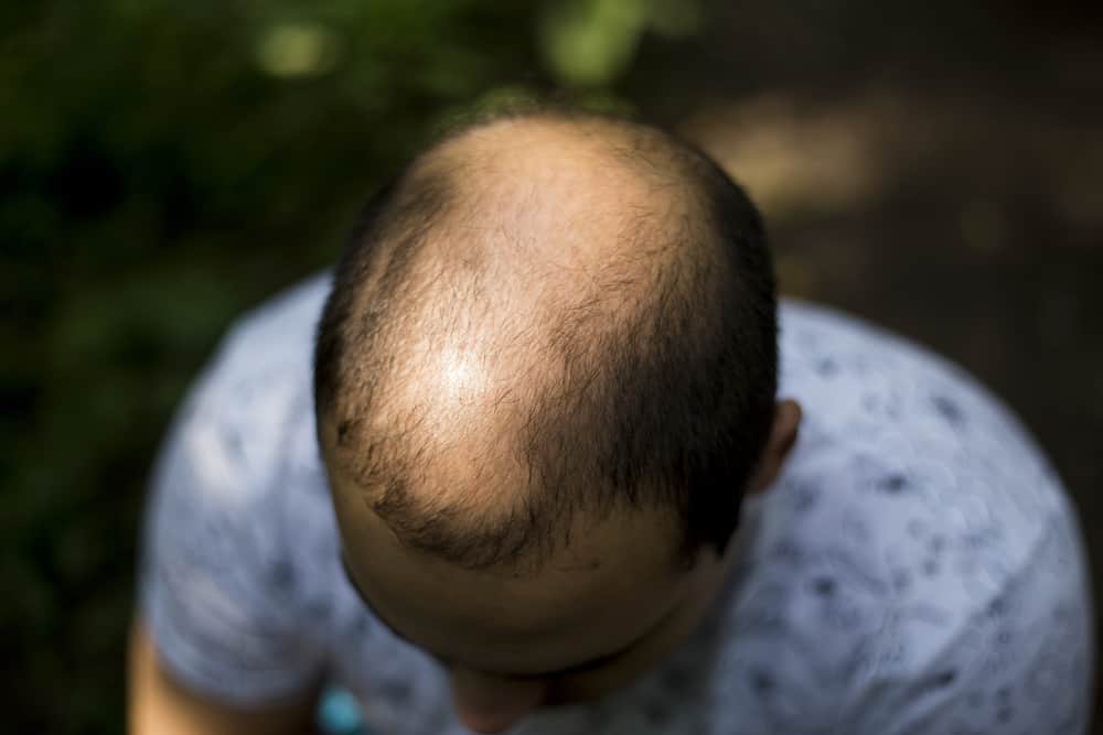 Male Pattern Baldness : मेल पैटर्न बाल्डनेस क्या है?