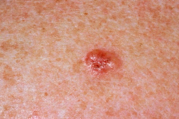 स्किन कैंसर के 10 लक्षण, जिन्हें आप अनदेखा न करें