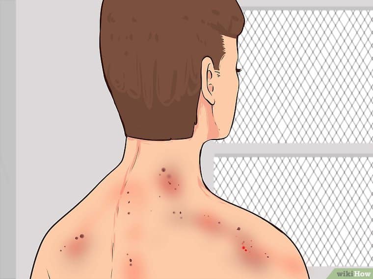 Radiation sickness : रेडिएशन सिकनेस क्या है? जानें इसके लक्षण, कारण और उपाय