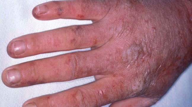 Porphyria : पोरफाइरिया क्या है?