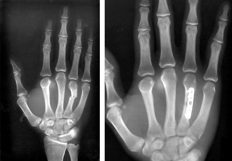 Broken (Fractured) Hand : हाथ का फ्रैक्चर क्या है? जानें इसके कारण, लक्षण और उपाय