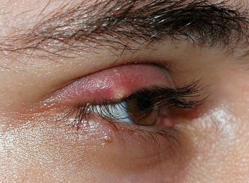 Eye stye: आई स्टाइ (गुहेरी) क्या है? जानें इसके लक्षण व कारण
