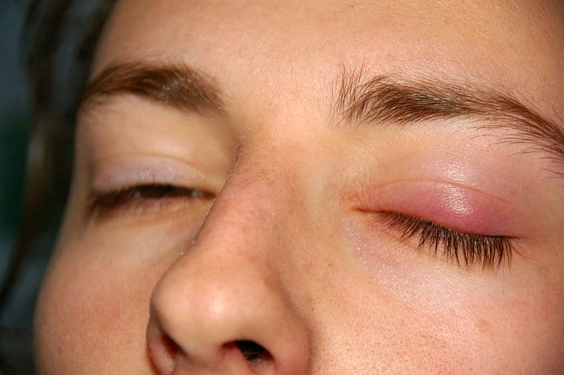 Chalazion: पलकों पर गांठ की बीमारी कैसे होती है, जानिए इसके लक्षण और उपचार