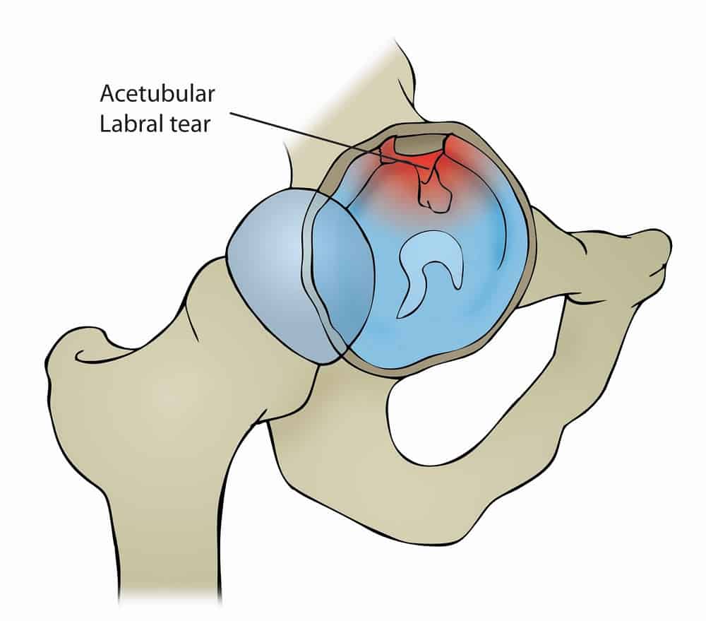 Hip (acetabular) labral tear: हिप (एसेटाबुलर) लेब्रल टीयर क्या है?