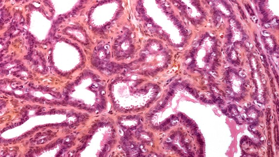 Mastitis (infectious) : मैस्टाइटिस क्या है?