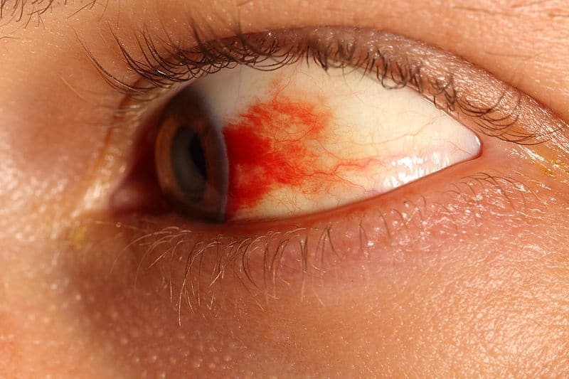 Subconjunctival hemorrhage : सबकन्जक्टिवा हैमरेज क्या है? जानें कारण, लक्षण व निवारण