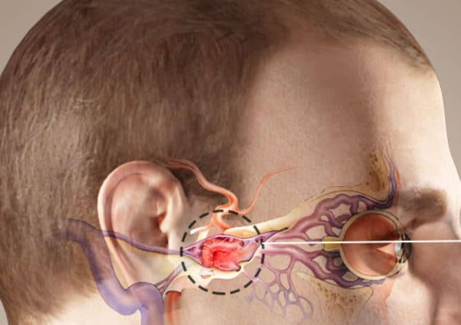 Cavernous Sinus Thrombosis : कैवर्नस साइनस थ्रोम्बोसिस क्या है?