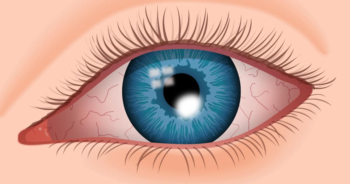 Corneal ulcer: कॉर्नियल अल्सर क्या है? जानें इसके कारण, लक्षण और उपचार