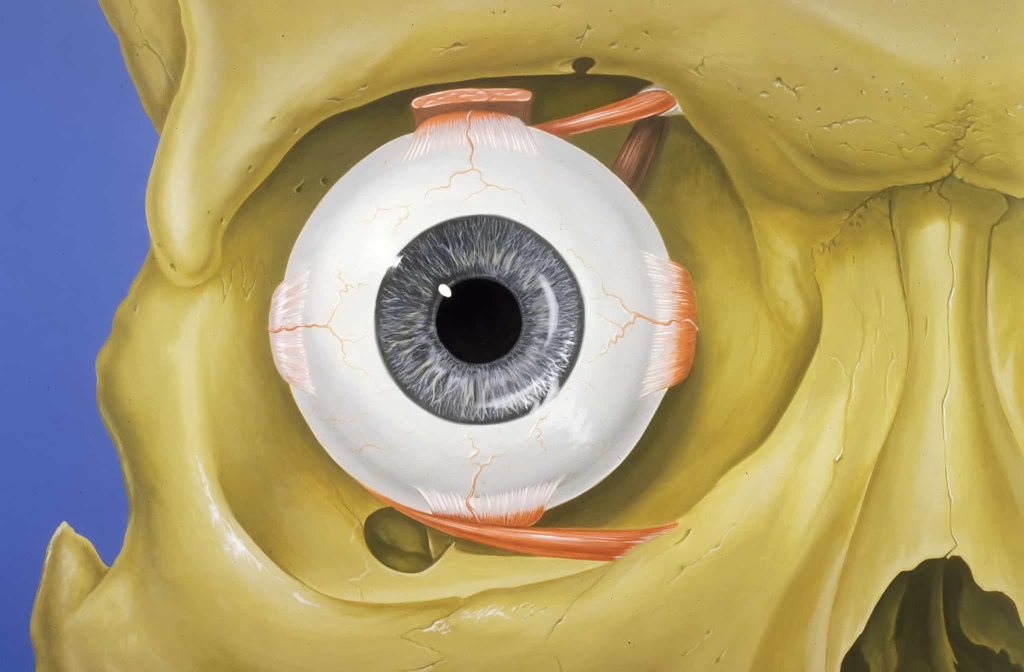 Eye socket fracture
