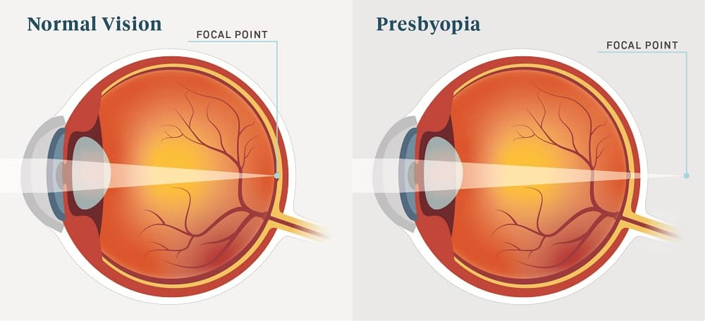 Farsightedness (presbyopia): दूर दृष्टि दोष क्या है?