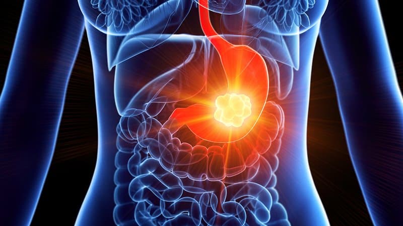 Gastric Cancer: गैस्ट्रिक कैंसर का पता कैसे लगता है? जानें इसके लक्षण