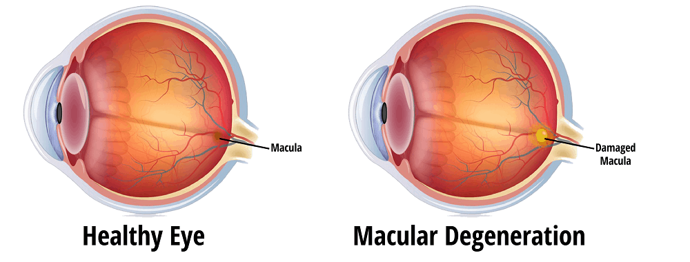 Macular Degeneration : मैक्युलर डीजेनेरेशन क्या है?