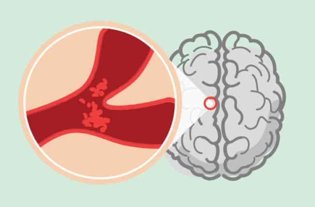 जानें स्ट्रोक के लक्षण, कारण और इलाज