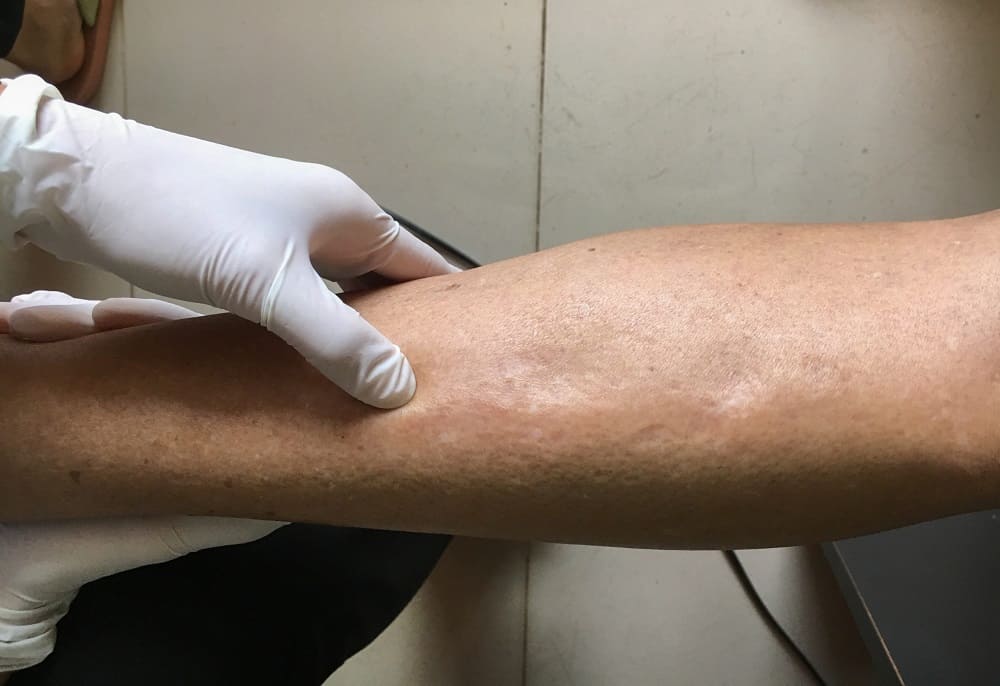 Peripheral Vascular Disease: पेरिफेरल वैस्कुलर डिजीज क्या है?