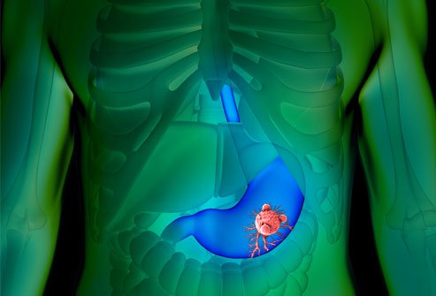 Stomach Tumor: पेट में ट्यूमर होना कितना खतरनाक है? जानें इसके लक्षण