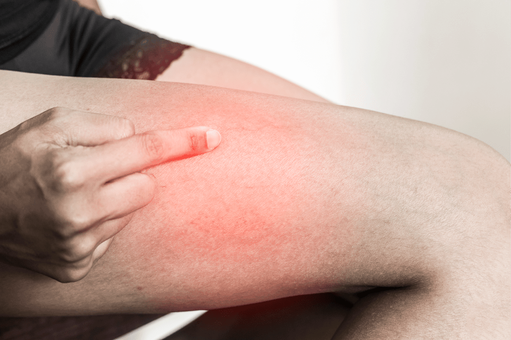 Thrombophlebitis : थ्रोम्बोफ्लिबिटिस क्या है?