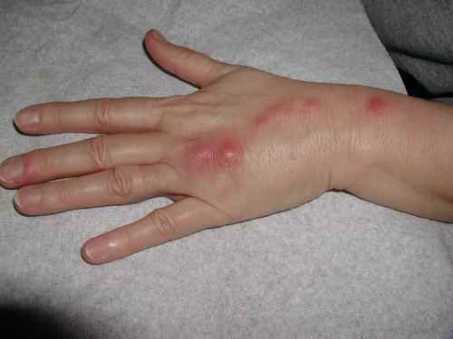 Sporotrichosis: स्पोरोट्राइकोसिस क्या है? जानिए इसके कारण, लक्षण और उपचार