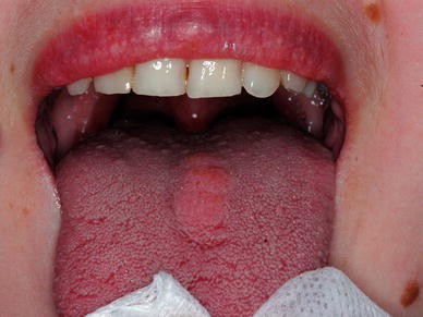 Amyloidosis: एमिलॉयडोसिस क्या है? जानिए लक्षण, कारण और उपाय