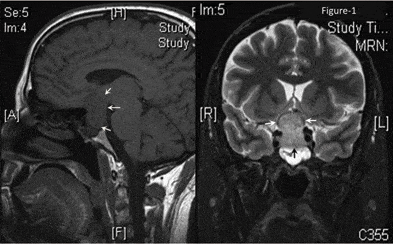 Transient global amnesia : ट्रांसिएंट ग्लोबल एमनेशिया क्या है?
