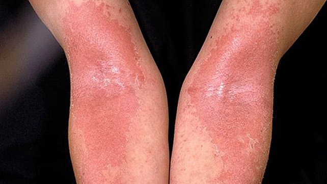 Eczema (Infants): बेबी एक्जिमा क्या है? जानें इसके कारण, लक्षण और उपाय