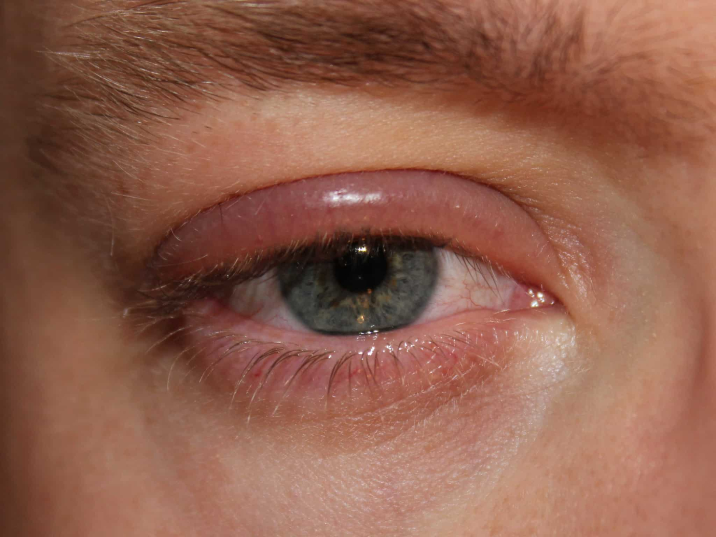 Blepharitis : ब्लेफेराइटिस (पलकों की सूजन) क्या है? जानें इसके कारण, लक्षण और उपाय