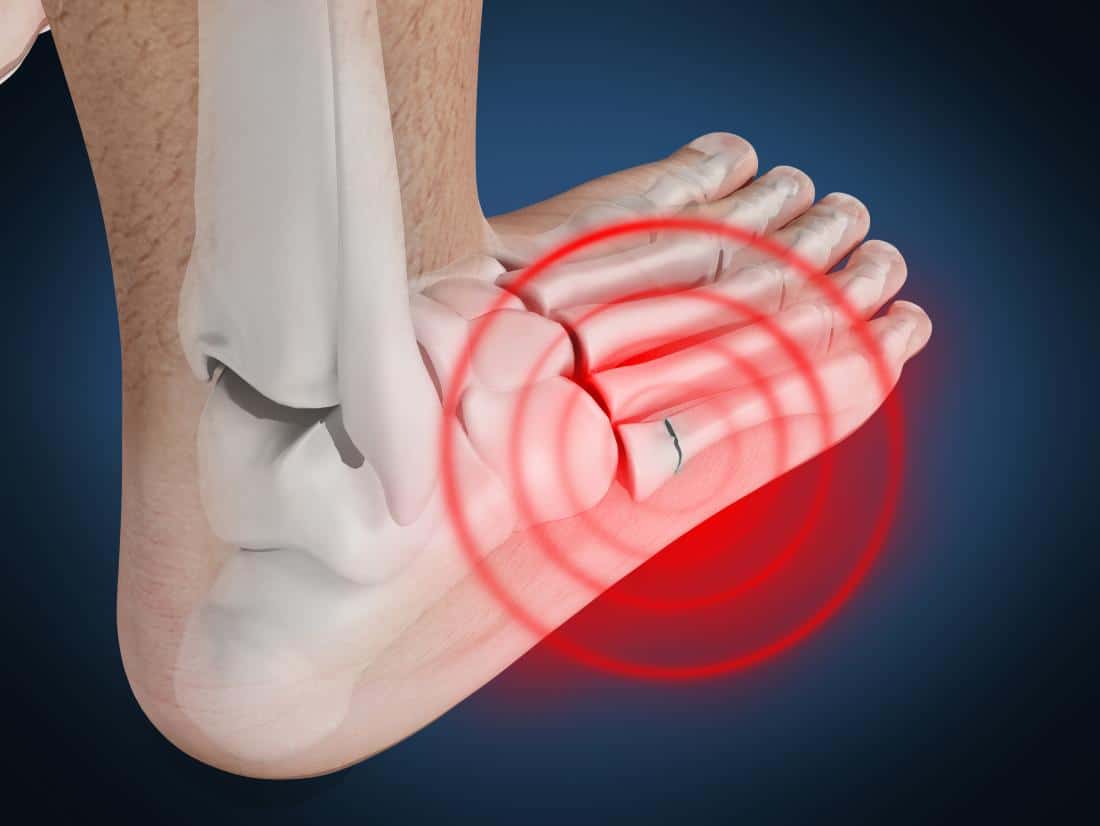 Broken (Fractured) Foot: ब्रोकन लेग क्या है? जानें इसके कारण, लक्षण और उपाय