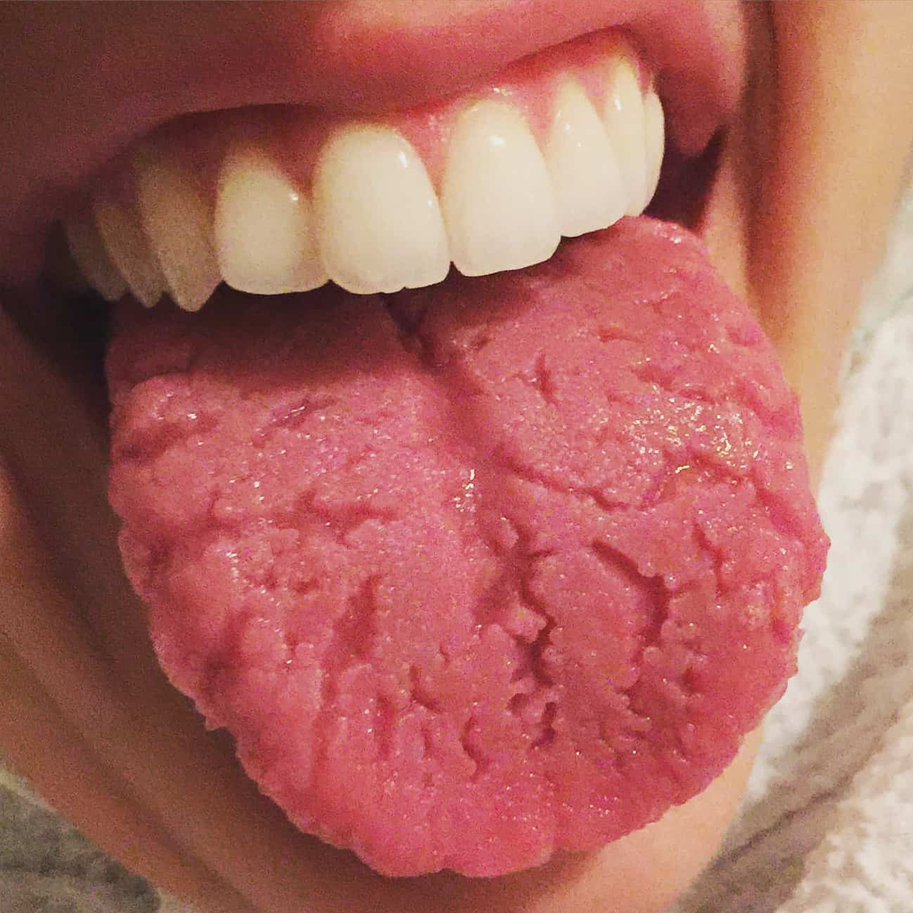 Fissured Tongue: फिशर्ड टंग (जीभ में दरार) क्या है? जानें इसके कारण, लक्षण और उपाय