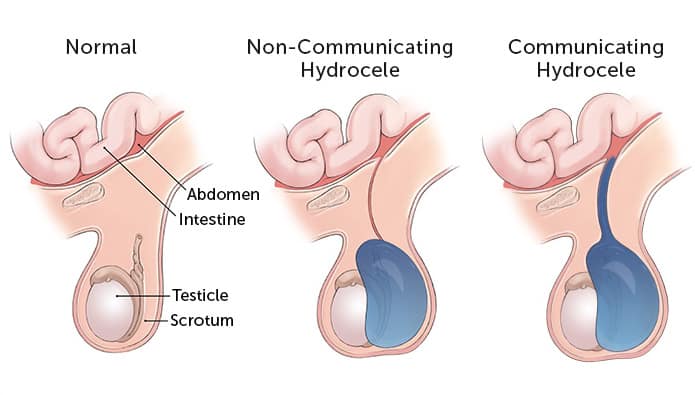Hydrocele: हाइड्रोसील क्या है?