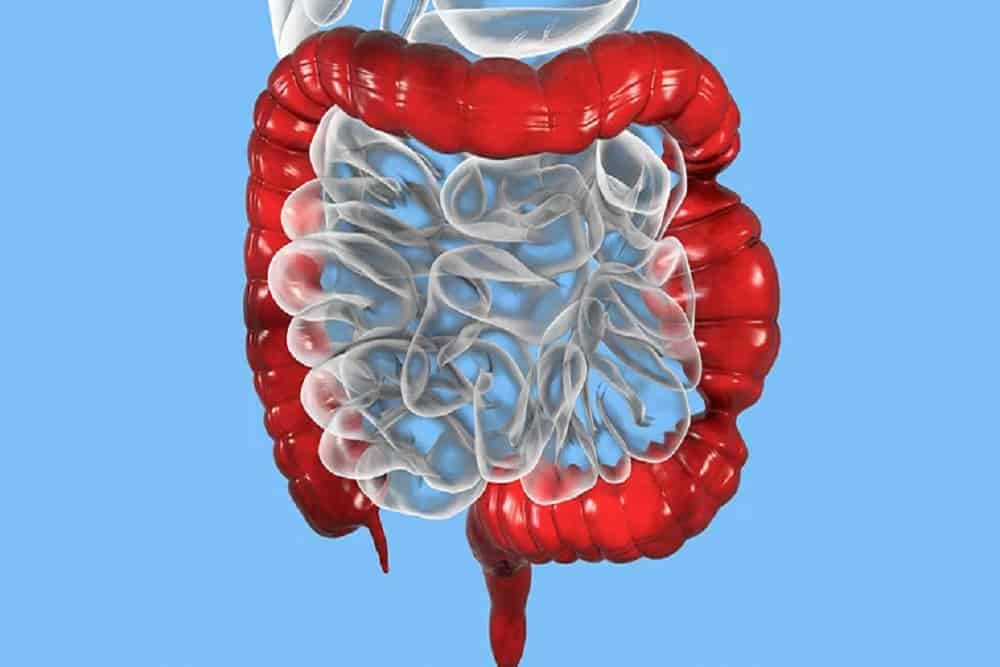 Irritable bowel syndrome (IBS): इरिटेबल बॉवेल सिंड्रोम क्या है? जानें इसके कारण, लक्षण और उपाय