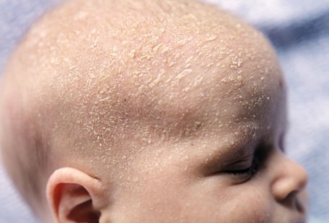 Cradle Cap : क्रैडल कैप क्या है?