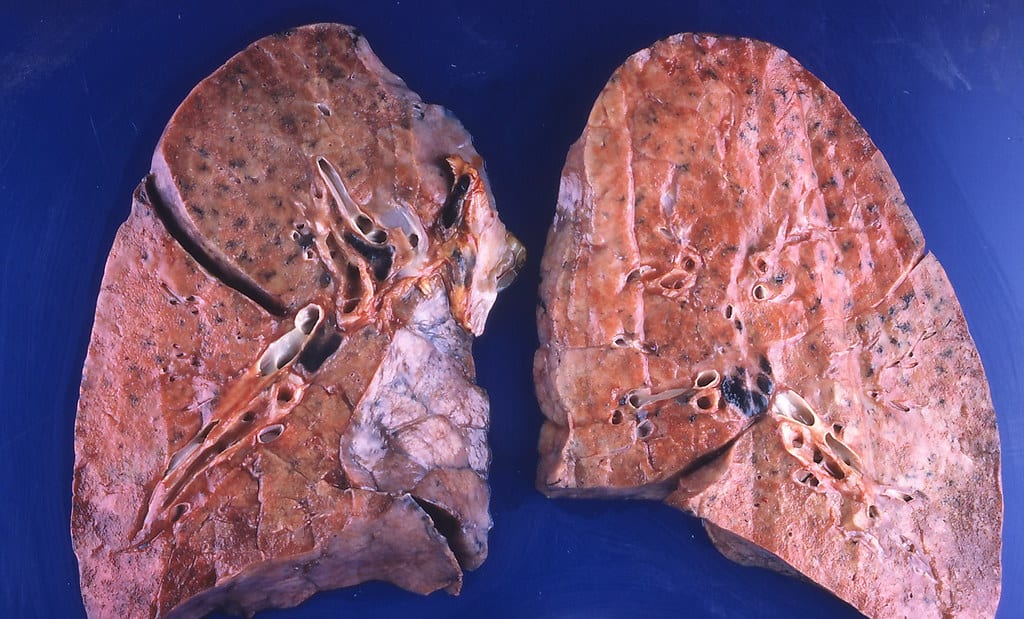 Quiz: क्यों जरूरी है निमोनिया की रोकथाम?