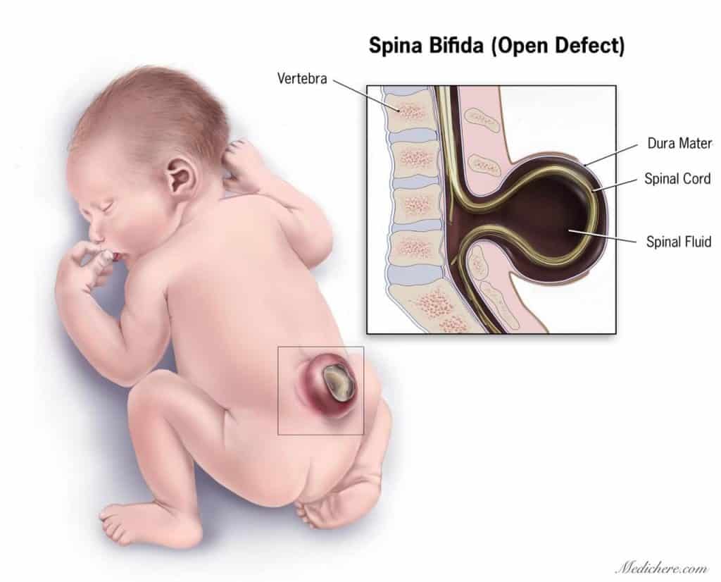 Spina Bifida : स्पाइना बिफिडा क्या है?